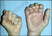 Hand - Complex Regional Pain Syndrome 